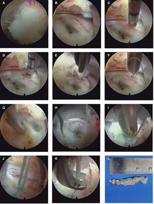 A retrospective study of the mid-term efficacy of full-endoscopic annulus fibrosus suture following lumbar discectomy